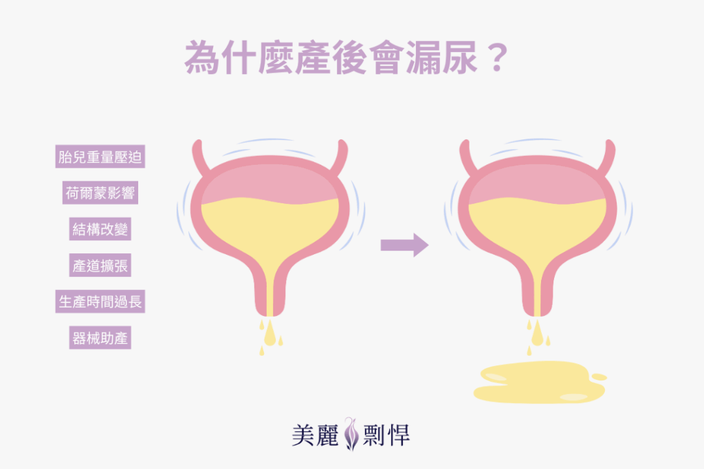 產後漏尿原因是什麼