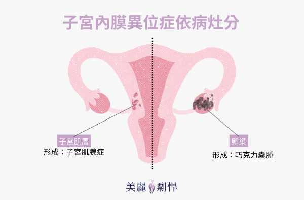 子宮內膜常見異位位置